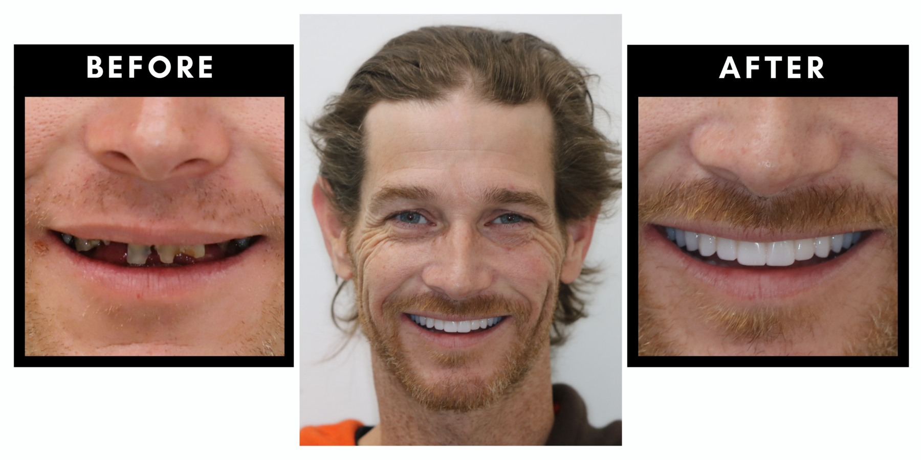 Before and after dental treatment showing transformative results